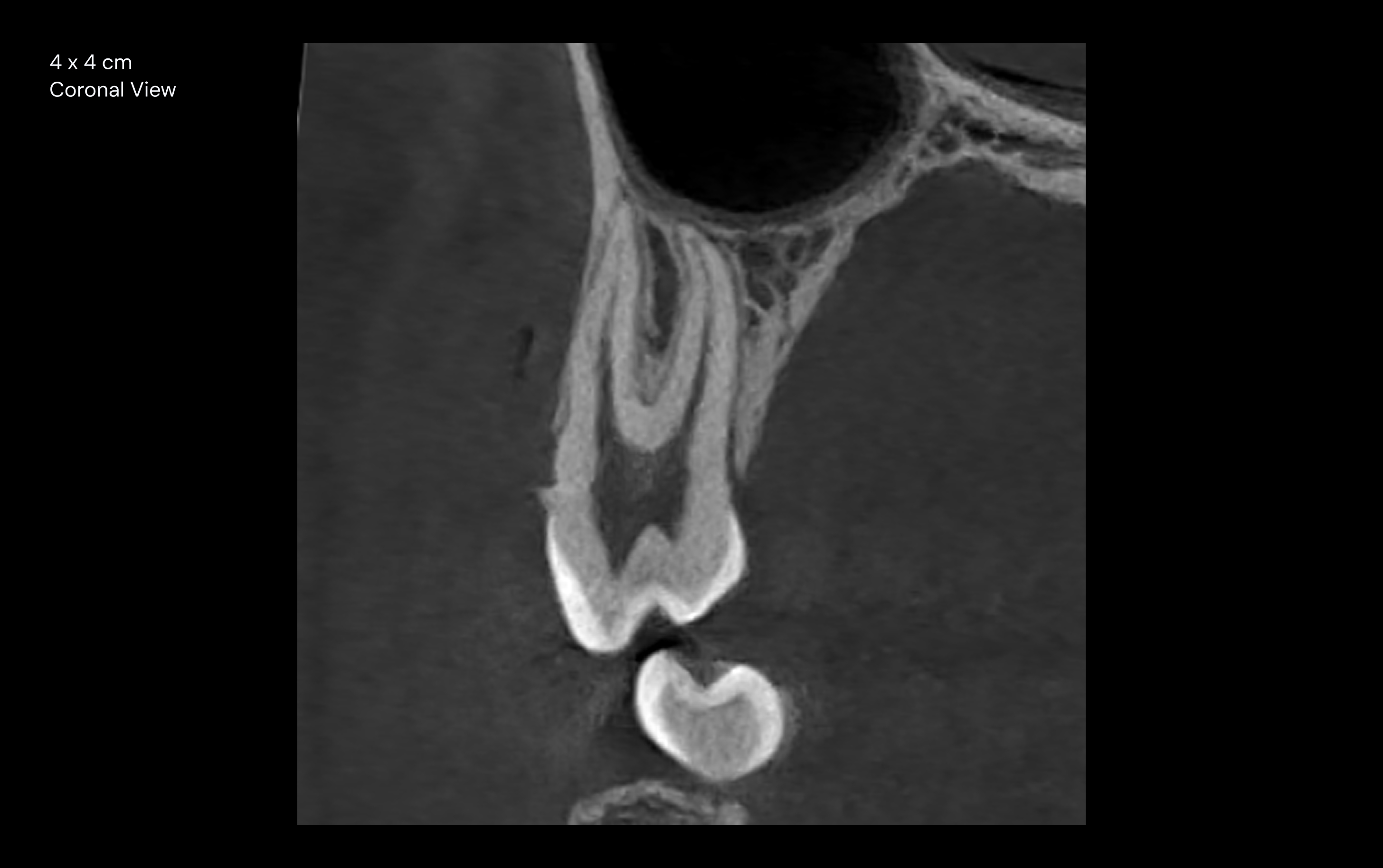 4 x 4 cm Coronal View